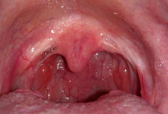 syphilis sore pictures #11