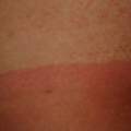 Sonnenbrand ja?