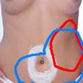 Stechen im linken Bauch,was kann das sein?