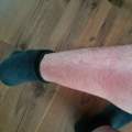 Total rote Beine!!! :o HILFE!