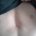 Trichterbrust :( Hilfe :/