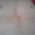 Trichterbrust :( Hilfe :/