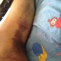 umstellungsosteotomie am link knie