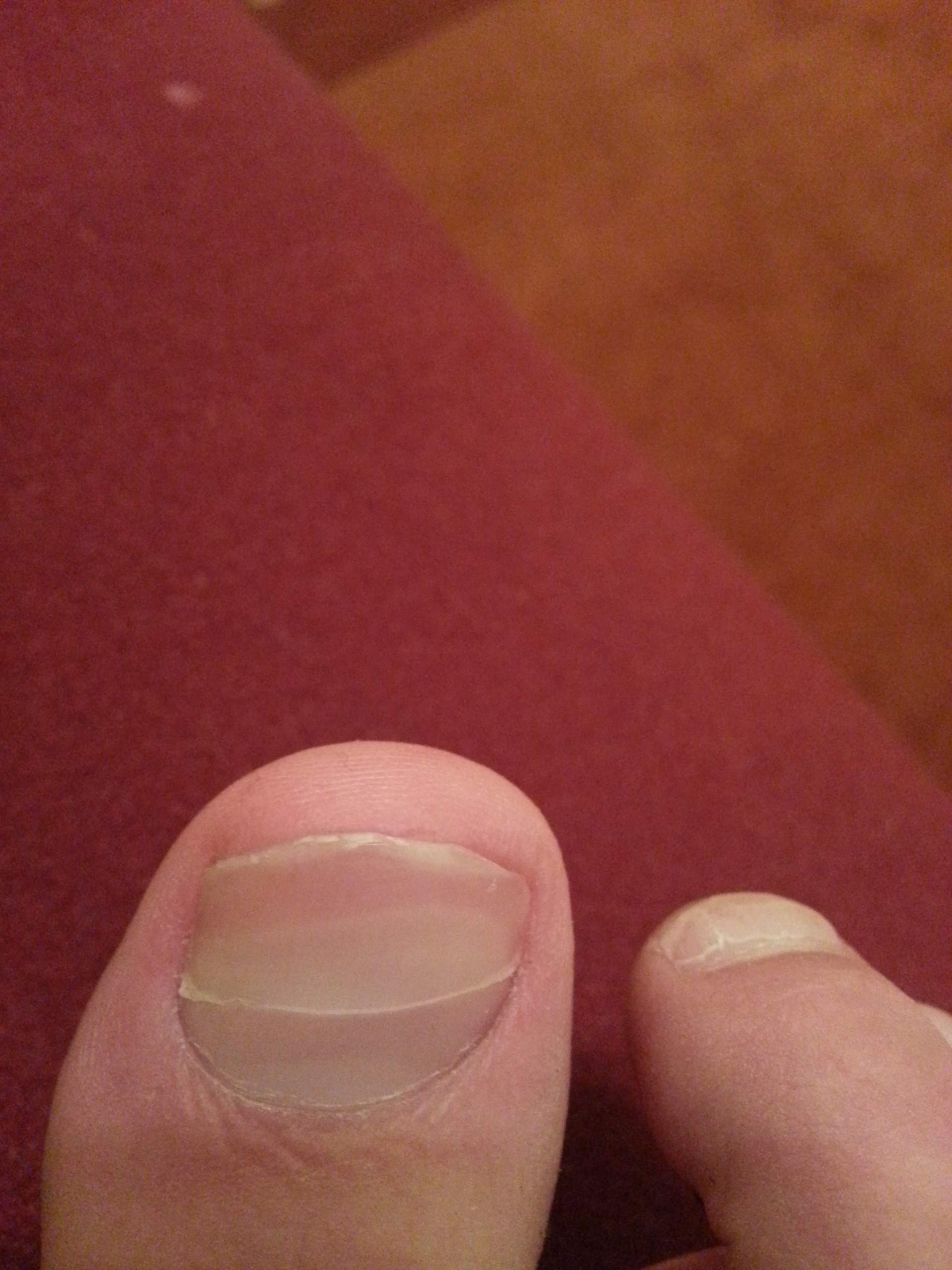 Neuer Nagel Wächst Unter Altem