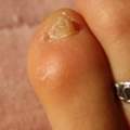 Was ist da mit meinen Zehennägeln los? Nagelpilz, Durchblutungsstörung oder etwas ganz Anderes?
