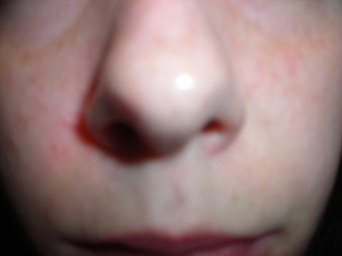 kleine pusteln im gesicht jucken