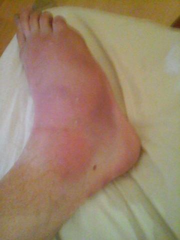 Fuß Gebrochen Oder Verstaucht