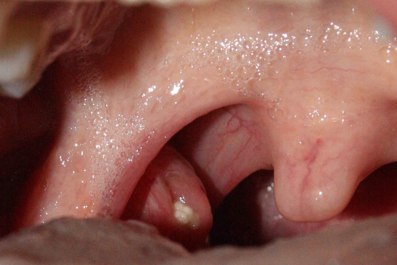 Weiße Flecken Auf Mandeln