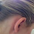Welche Creme bei Neurodermitis-