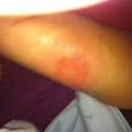 Wespenstich Allergie nach 24std?