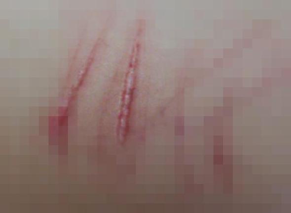 Wie von gribka der Nägel auf den Beinen zu befreien