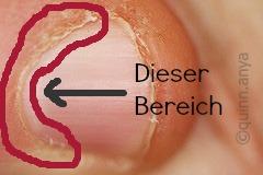 Gribok auf der Haut der Beine die Abschuppung
