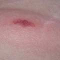 Würdet ihr nach euren Erfahrungen bestätigen, dass ich an einer Gürtelrose leide?