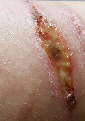 Entzündete Wunde Was Tun