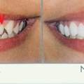 Zahn- Veneers