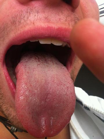 Zunge in Ordnung (Krankheit, Zungenbelag)