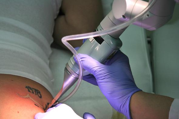 Tattooentfernung mit Laser (c) Copyright DocTattooentfernung 2013 - (Kosten, Tattoo, Laser)