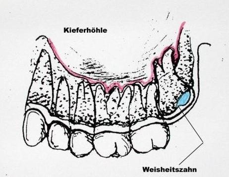 Bild 2 - (Gesundheit, Schmerzen, Zähne)