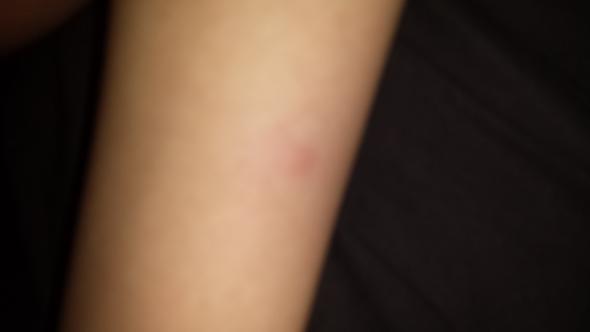 Bisse Oder Stiche In Der Nacht Bett Stich Nachts