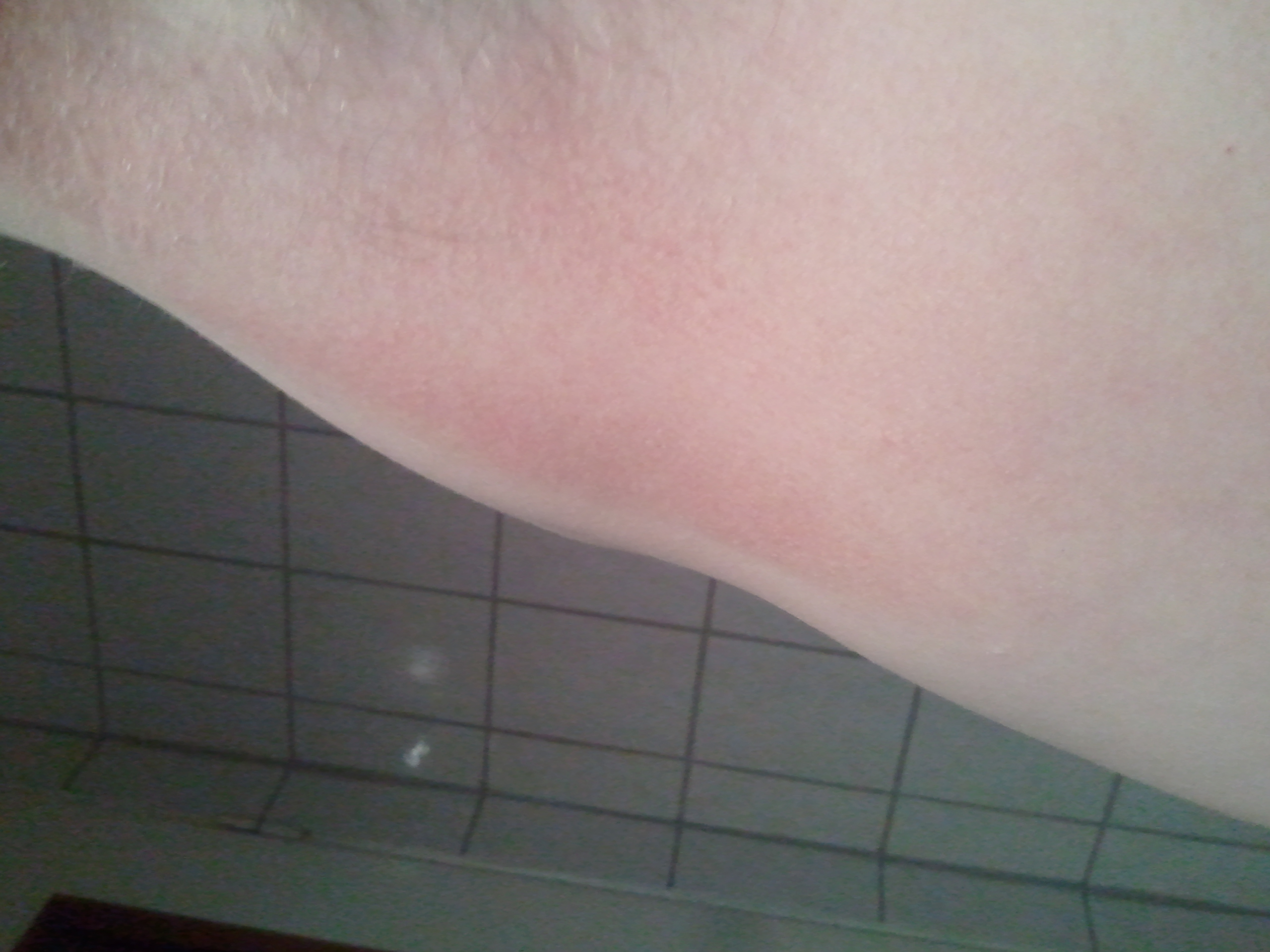 Tipps gegen Hautpilz! (Flecken, trocken, achseln)