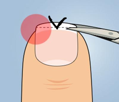 Nagelpflege gegen einwachsen - (Nägel, Zeh, eingewachsen)