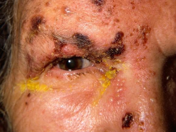 Hat jemand Erfahrungen mit Gürtelrose im Gesicht? (Gesundheit, Behandlung) Hat jemand Erfahrungen mit Gürtelrose im Gesicht? (Gesundheit, Behandlung)