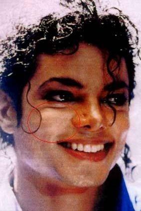 Michael Jackson mit vitiligo - (Operation, Michael Jackson)