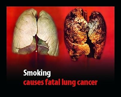 Raucherlung - (Gesundheit, Rauchen, Lunge)
