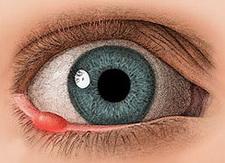 Kleine Blase Am Unteren Augenlid Was Ist Das Medizin Augen