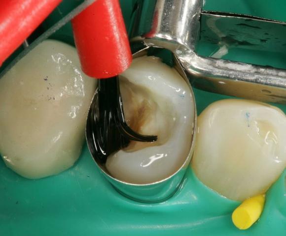 Hilfee Zahnschmerzen Und Blaues Zahnfleisch Arzt Schmerzen Zahne