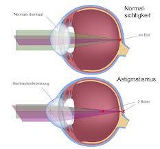 Verkrümmung 3 - (Augen, Brille, Kontaktlinsen)