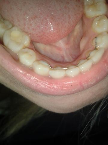 Draht Unterzähne - (Zähne, Zahnarzt, Zahnspange)