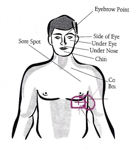 Akute Nebenhöhlenentzündung (Sinusitis Symptome, Diagnose)