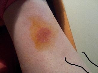 Was Ist Das Gurtelrose Krankheit Herpes Immunsystem Was Ist Das Gurtelrose Krankheit Herpes Immunsystem