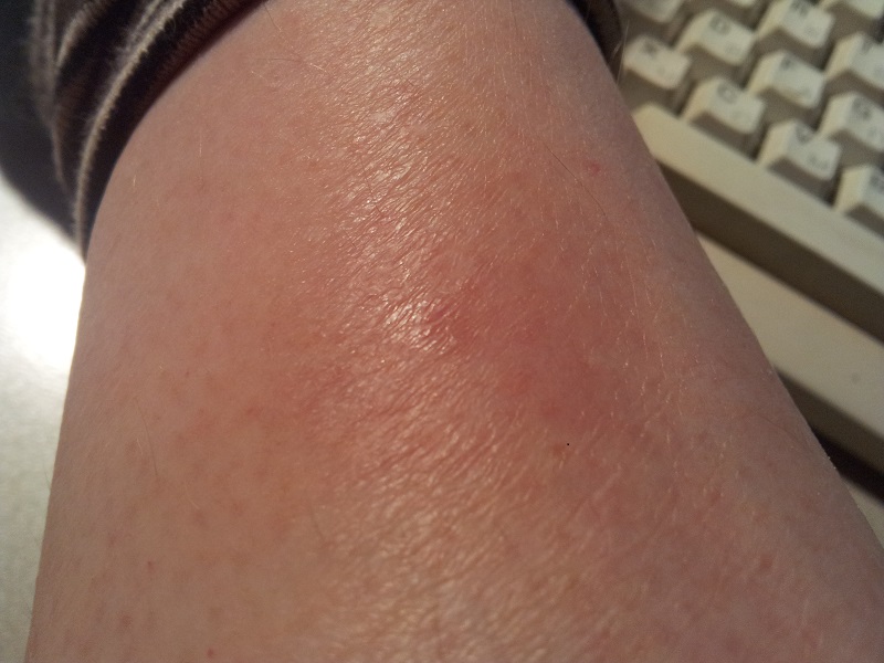 Was ist das? Gürtelrose? (Krankheit, Herpes, Immunsystem)