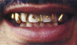 Goldfüllung - (Gesundheit, Zähne, Zahnarzt)