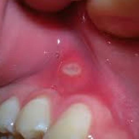 Aphtenbläschen im Mund - (Gesundheit, Angst, Schmerzen)
