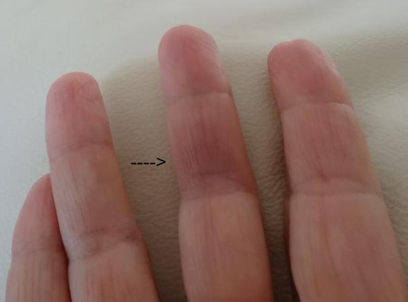 Finger mit Rötung - (Gesundheit, Allergie, Finger)