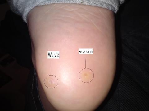 Fersensporn in jungen Jahren. Was tun? (Arzt, Verletzung, Orthopäde)