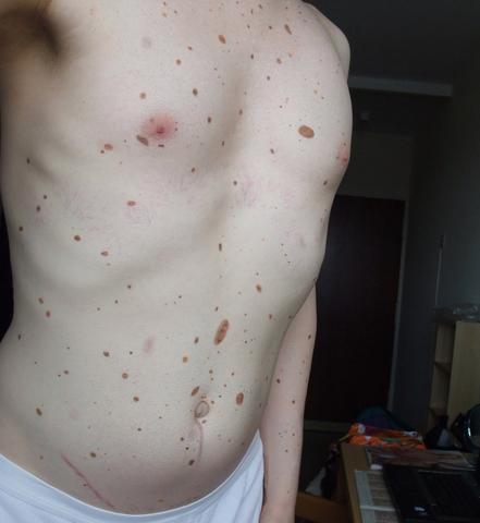 Ich Habe Viele Muttermale Im Gesicht Was Tun Hasslich Muttermal Ich Habe Viele Muttermale Im Gesicht Was Tun Hasslich Muttermal