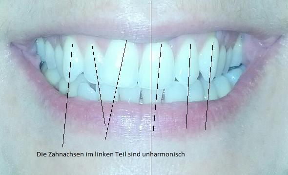 Zahnachsen bei dir - (Zähne, Zahnspange, Kompositfüllung)