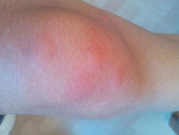 Rote Flecken Bisse Am Knie Wanzen Floh Oder Grasmilbenbiss Gesundheit Insekten Flohe Rote Flecken Bisse Am Knie Wanzen Floh Oder Grasmilbenbiss Gesundheit Insekten Flohe
