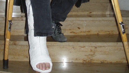 Wie kann man am Besten mit Knieschienen Treppensteigen? (Medizin, krücken)