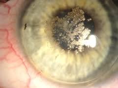 Ablagerungen - (Augen, Kontaktlinsen, Augenarzt)
