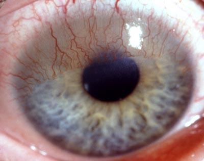 Einsprossungen - (Augen, Nacht, Kontaktlinsen)