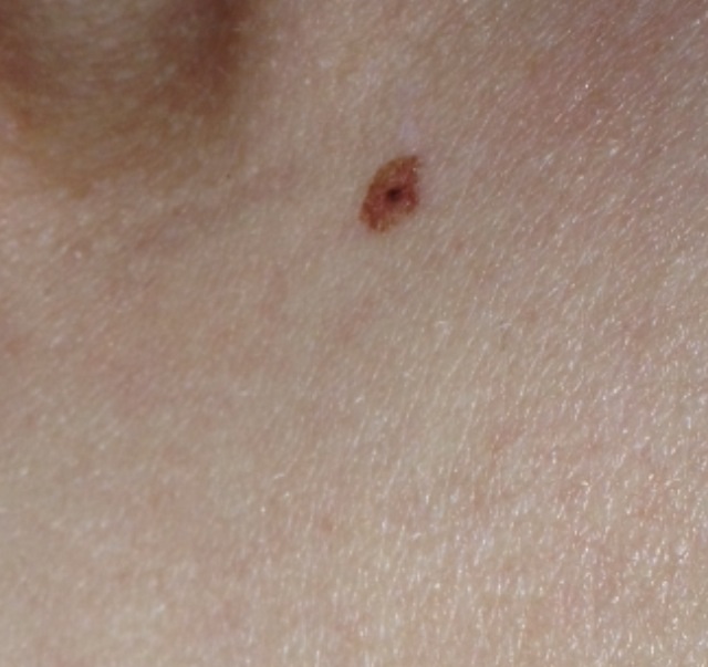 Fleck um Muttermal nach paar mal Solarium (Gesundheit, Haut, Krebs)