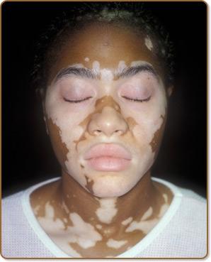Vitiligo - (Haut, Michael Jackson, Pigmentstörung)