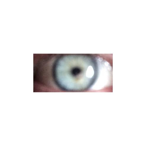 - (iris, Pigmente, melanom)
