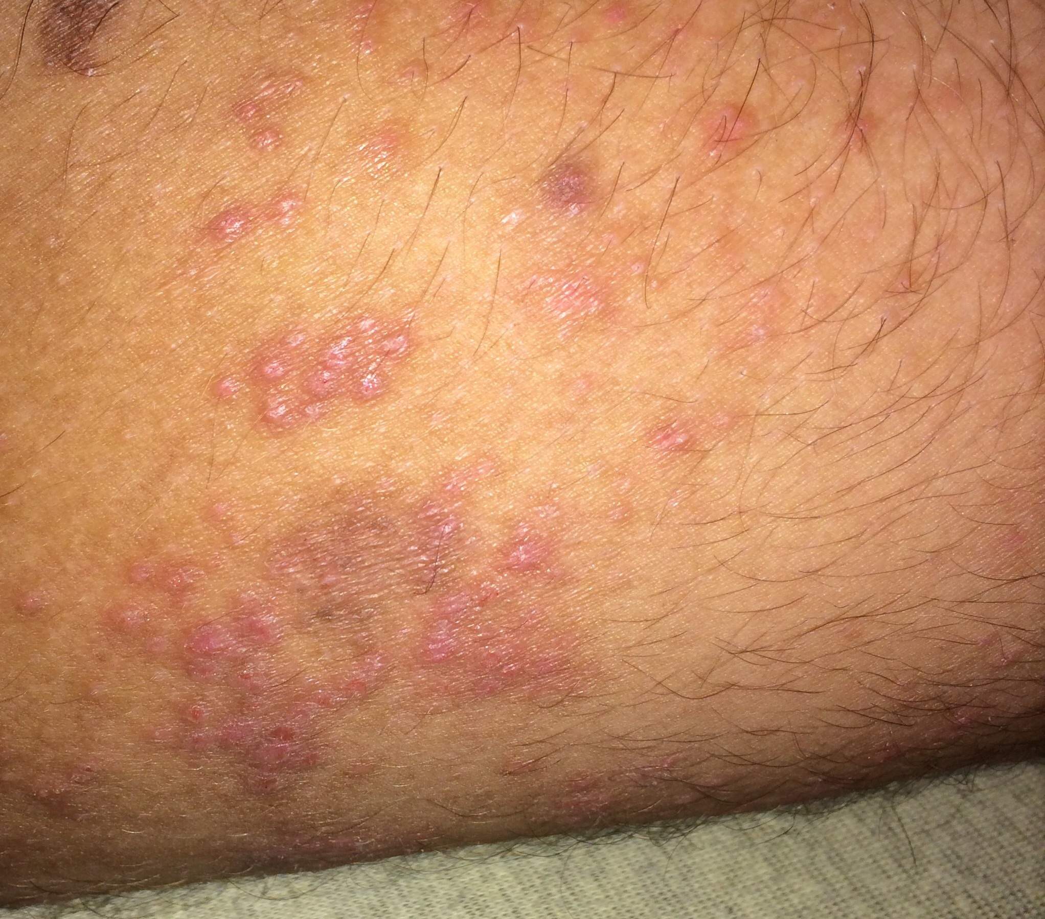 Rote Pusteln am Oberschenkel Was kann das sein(? (Gesundheit, Medizin, Krankheit) Rote Pusteln am Oberschenkel Was kann das sein(? (Gesundheit, Medizin, Krankheit)
