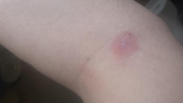 - (Haut, Ausschlag)